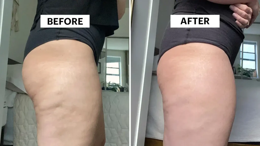 Do Toning Exercise Oxted Really Tackle Cellulite?