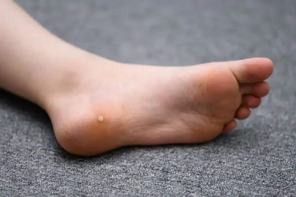 Cryotherapy For Warts And Also Verrucas 2 Image of verruca on the bottom of the foot that able to be treated with Cryotherapy Oxted
