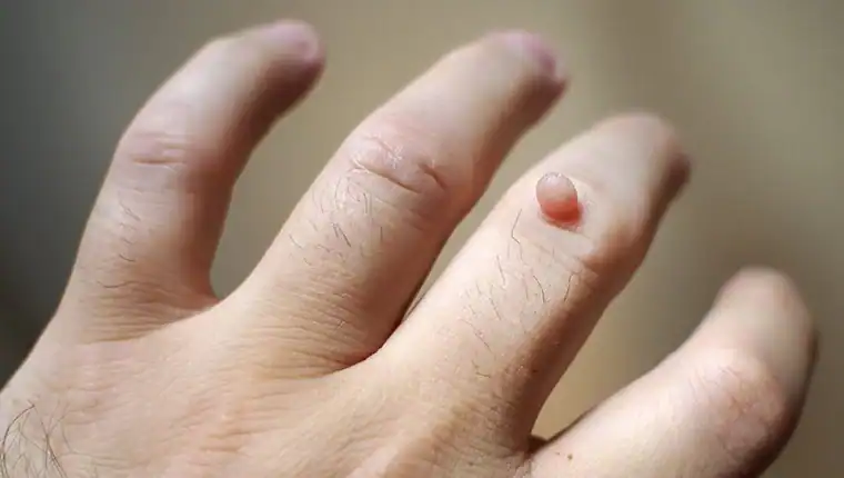 Cryotherapy For Warts And Also Verrucas 1 Image of blemish that Cryotherapy Oxted can remove with Lipo 360.