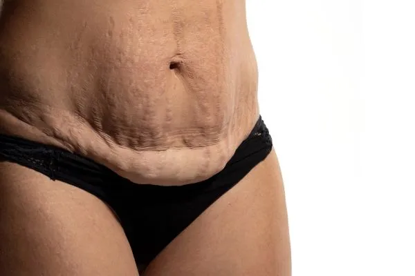 The Science of Skin Tightening 1 The science behind skin tightening Oxted picture of a woman's sagging skin on the stomach